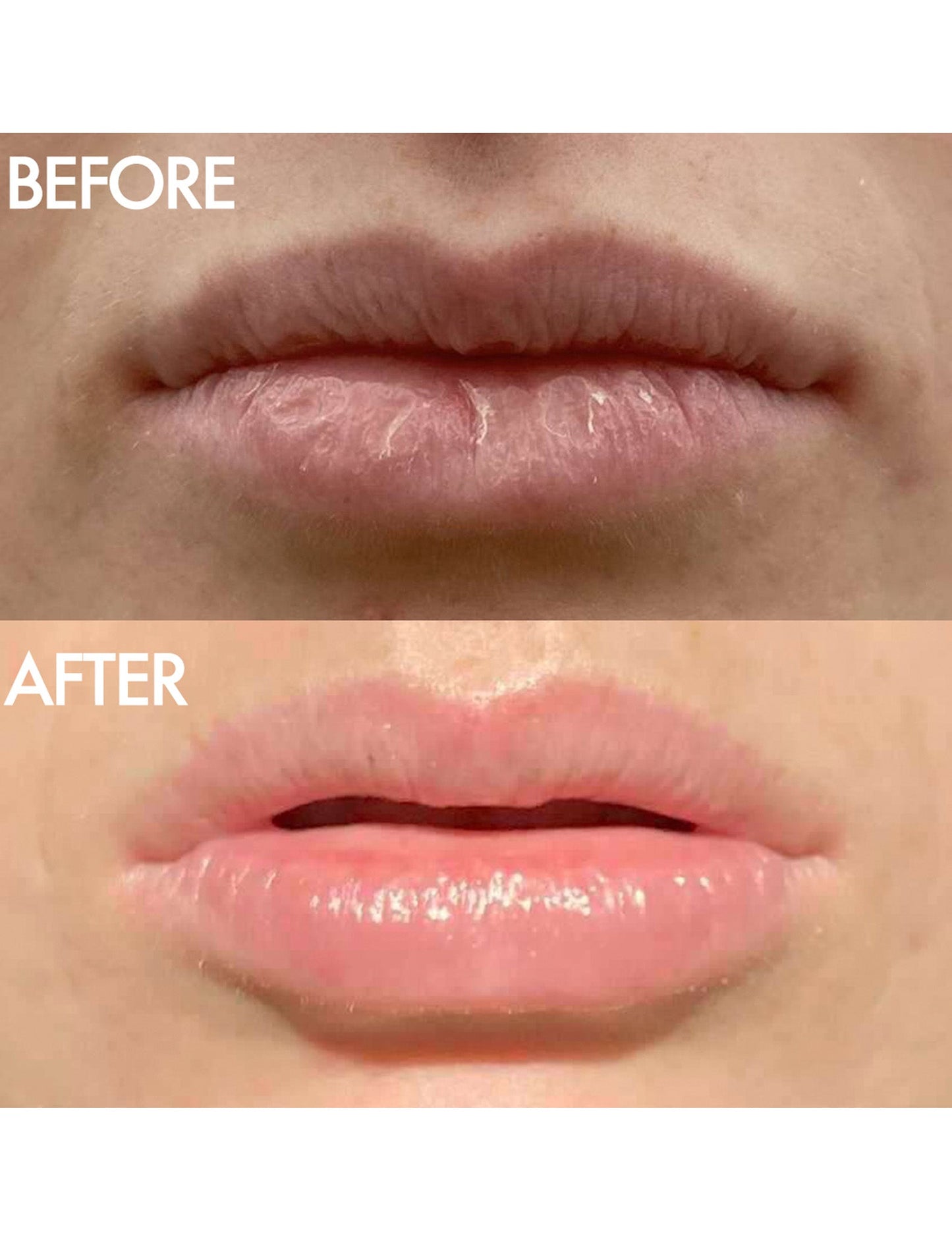 Before and after shot of Lanolips The Original 101 Ointment Multipurpose Superbalm. Top image shows dry, cracked lips; bottom image shows smooth, hydrated lips after using ultra-pure grade lanolin. Delivers intense hydration for lips, skin patches, cuticles, elbows and more. Safe for pregnancy, nursing mothers, and babies.