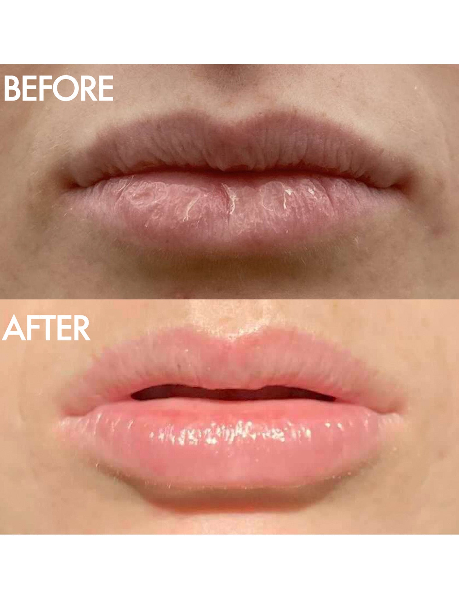 Before and after shot of Lanolips The Original 101 Ointment Multipurpose Superbalm. Top image shows dry, cracked lips; bottom image shows smooth, hydrated lips after using ultra-pure grade lanolin. Delivers intense hydration for lips, skin patches, cuticles, elbows and more. Safe for pregnancy, nursing mothers, and babies.